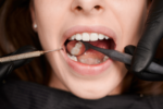 Protect Your Tooth Enamel and Prevent Dental Erosion