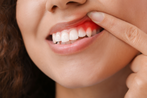 Tips and Tricks for Preventing Gum Disease