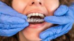 invisalign