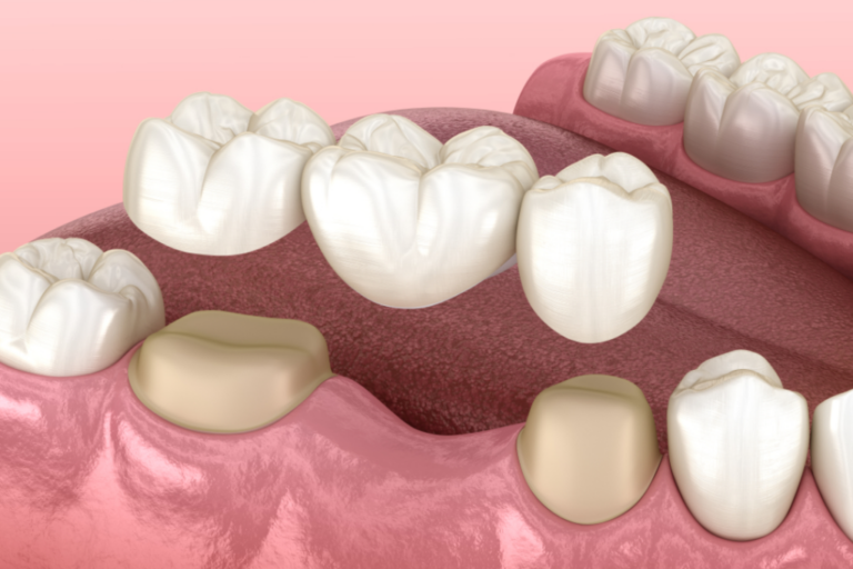 dental bridges demo for treatment