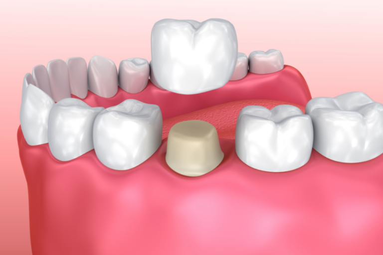 dental crowns demo
