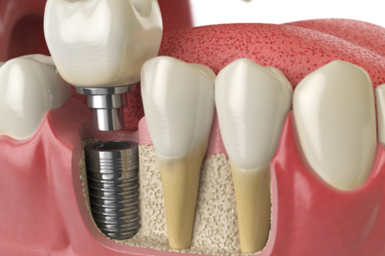 dental implants demo