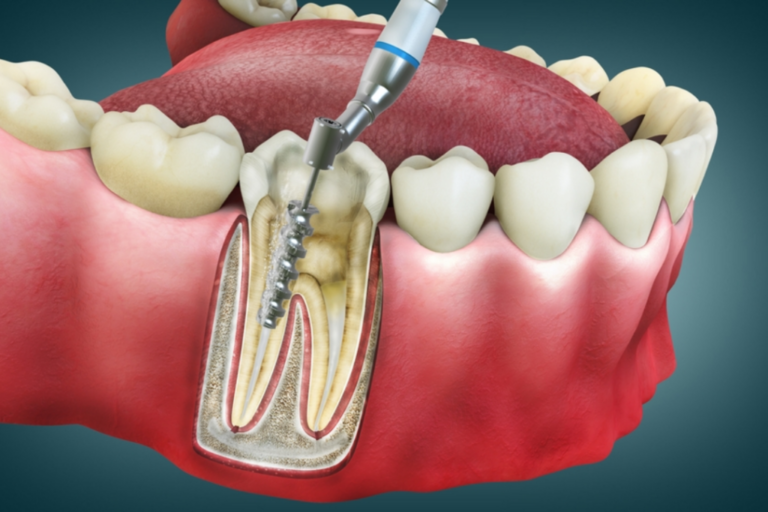 root canal treatment demo