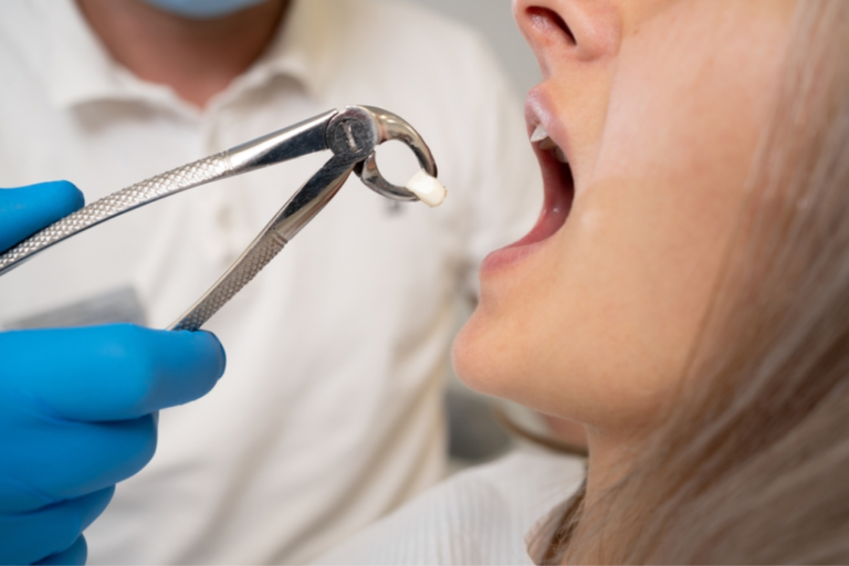 tooth extraction and tooth removal